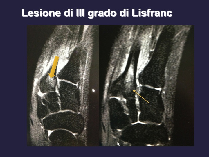 articolazione di Lisfranc